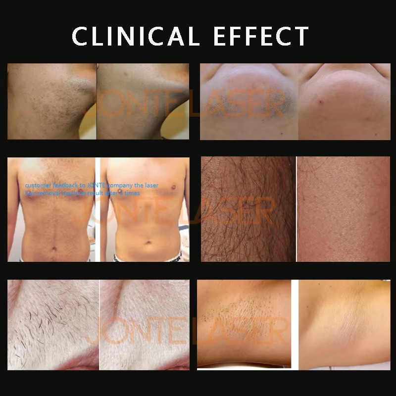 Portable Professional 1200W 75 - Diode Laser Hair Removal 808Nm 755Nm 1064Nm recension och pris