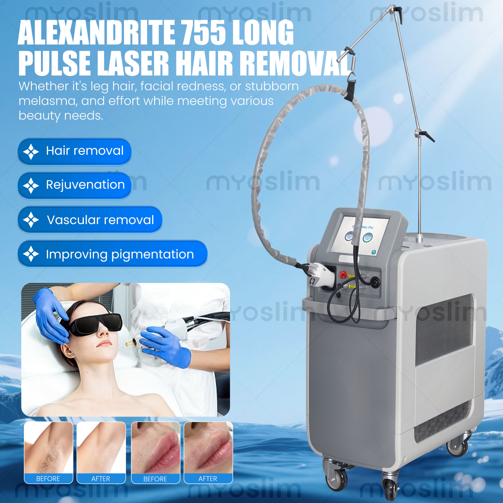755nm 1064nm Long Pulse Alexan - Alexandrite Laser Hair Removal Machine recension och pris
